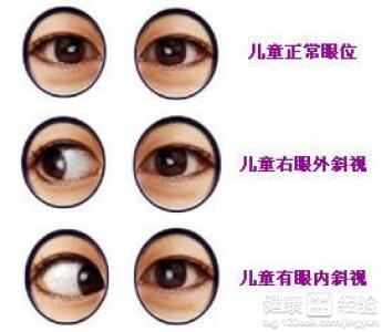 弱斜視要怎樣徹底治療