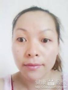 治療斜視是手術好還是糾正好呢
