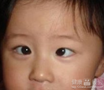麻痺性斜視要什麼治療
