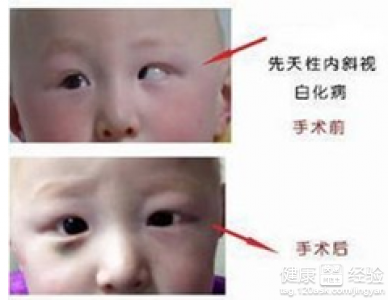 我24了是斜視治療的話用什麼方法好
