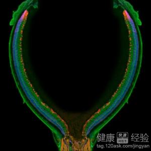 八歲男孩一千度近視加弱視斜視有愛怎麼治療