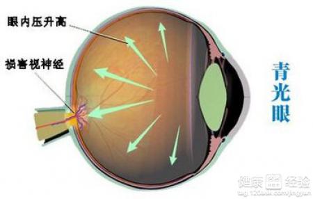 什麼是青光眼常見的青光眼類型有哪些？