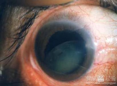 A型血的人更易患青光眼如何治療青光眼