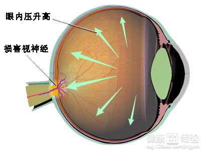 關愛年邁長輩莫讓青光眼奪走至親視力