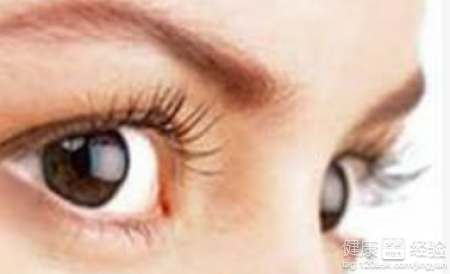 科普：青光眼的不同症狀和不同分類