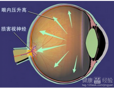 滴眼藥水滴出青光眼青光眼如何檢查