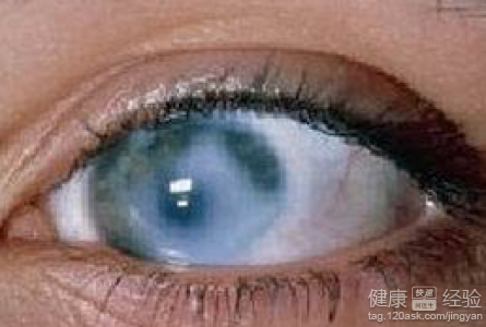 青光眼竟致眼疾4大方法治愈青光眼