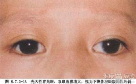 兒童青光眼該怎麼治療才能好