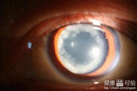 青光眼手術的後遺症有哪些？