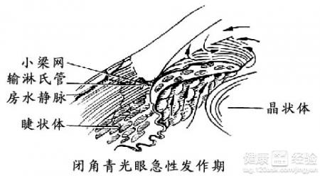 青光眼診斷青光眼的治療偏方