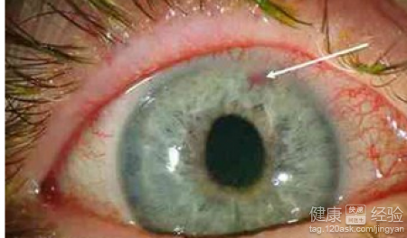 開角型青光眼導致失明的原因