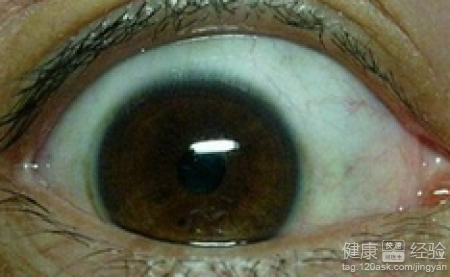 產生繼發性青光眼的主要因素