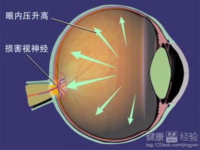 青光眼避免失明需及時治療