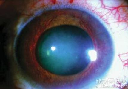 警惕青光眼防治的三大誤區