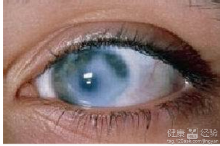 你應該知道的青光眼5大常識