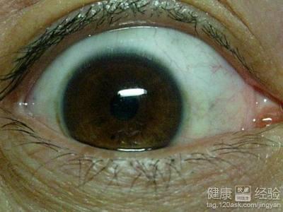青光眼治療降眼壓有效治療方法