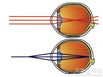 食療治療青光眼能治好嗎