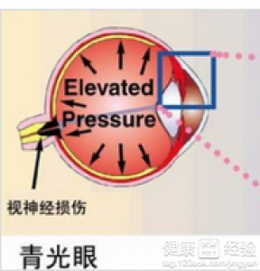 治療青光眼采用中醫療法