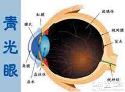 揭秘各類青光眼的危險因素