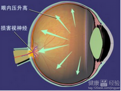 先天性青光眼的病因是什麼