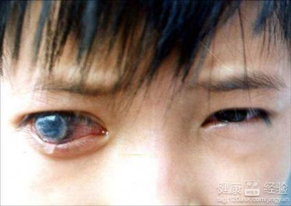 繼發性青光眼的病因有哪些