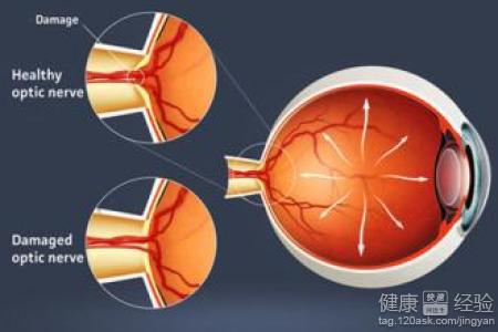 遠視眼更容易得青光眼