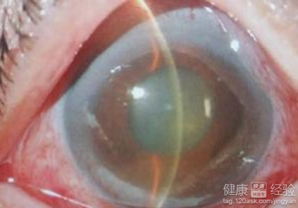 青光眼患者請注意睡姿