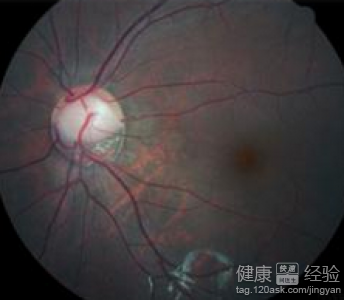 頭痛是青光眼在作祟？