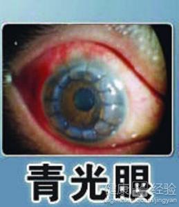 青光眼一定要定期復查早期診斷青光眼新法