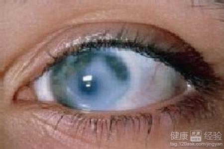 如何發現青光眼不同類型青光眼有不同的表現