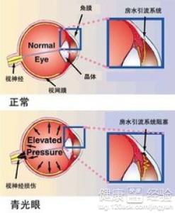 先天性青光眼會失明嗎