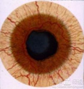 新生血管性青光眼治療方法