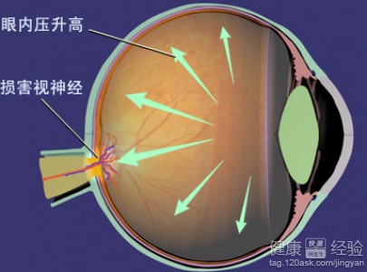 中醫調理治療青光眼