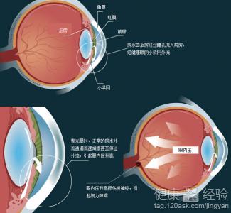 什麼是先天性青光眼