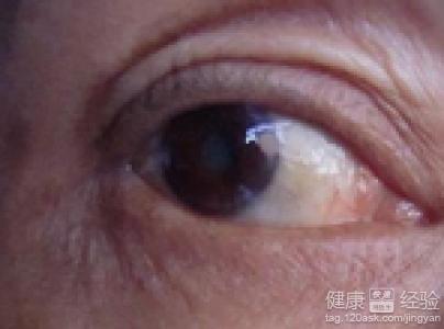 急性青光眼治療方法