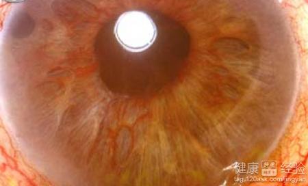 新生血管型青光眼如何保守治療