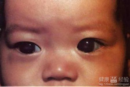 五歲的孩子為什麼會得青光眼