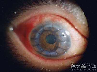 術後出現惡性青光眼,需藥物維持但常出現眼癢及水腫怎麼辦