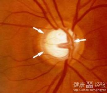 左眼葡萄膜炎繼發青光眼該怎麼辦