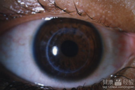 青光眼的5大早期症狀