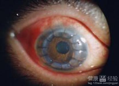 弱視青光眼能否用中醫正骨手法治愈