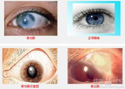 患了青光眼治療後眼壓不高怎麼回事