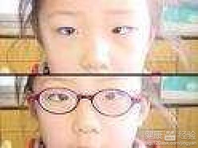青光眼的預防要注意什麼？