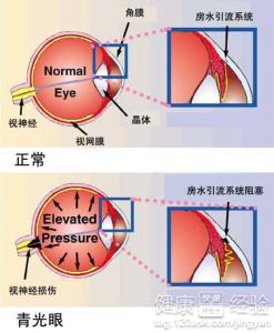 青光眼怎麼預防？