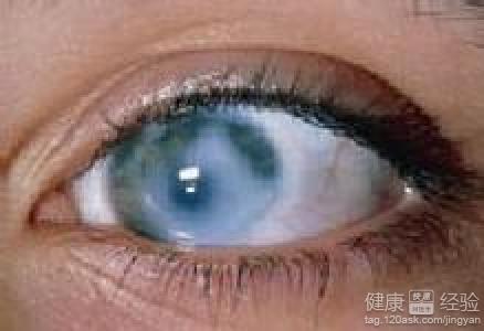 青光眼的症狀有哪些？