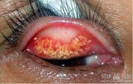 如果沙眼怎麼辦