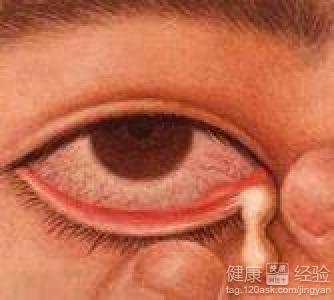 慢性淚囊炎怎麼辦