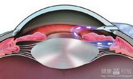 老年人怎樣才能有效的預防青光眼？