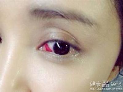 眼底出血有什麼樣的症狀表現
