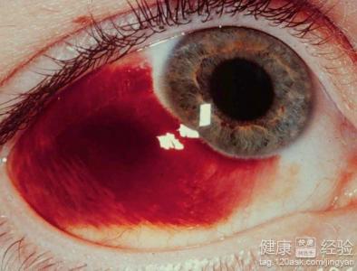 治療眼底出血手術前需要打針嗎
